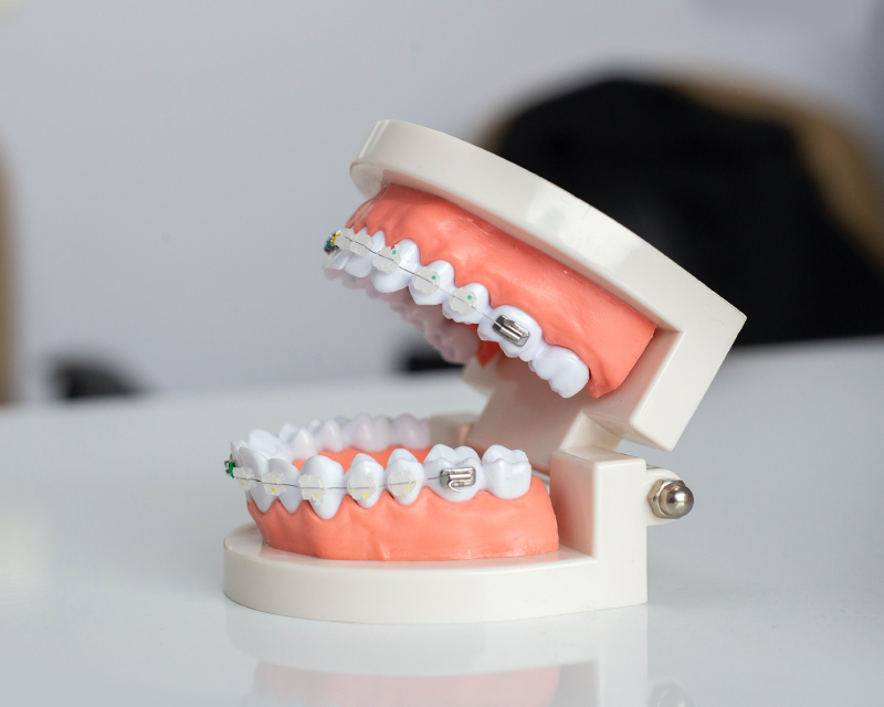  Knowledge of invisible braces